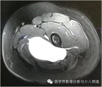 【病例】滑膜肉瘤2例CT及MR影像表现与鉴别 【病例】滑膜肉瘤2例CT及MR影像表现与鉴别