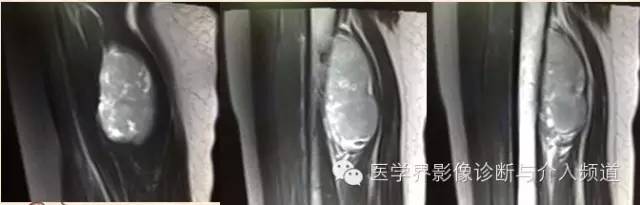 【病例】滑膜肉瘤2例CT及MR影像表现与鉴别 【病例】滑膜肉瘤2例CT及MR影像表现与鉴别