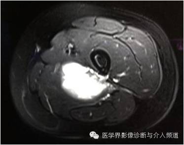 【病例】滑膜肉瘤2例CT及MR影像表现与鉴别 【病例】滑膜肉瘤2例CT及MR影像表现与鉴别