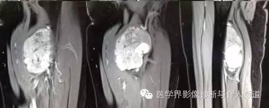 【病例】滑膜肉瘤2例CT及MR影像表现与鉴别 【病例】滑膜肉瘤2例CT及MR影像表现与鉴别