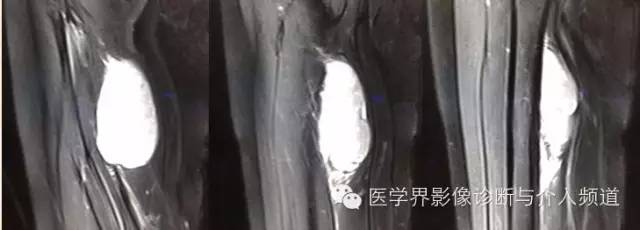 【病例】滑膜肉瘤2例CT及MR影像表现与鉴别 【病例】滑膜肉瘤2例CT及MR影像表现与鉴别