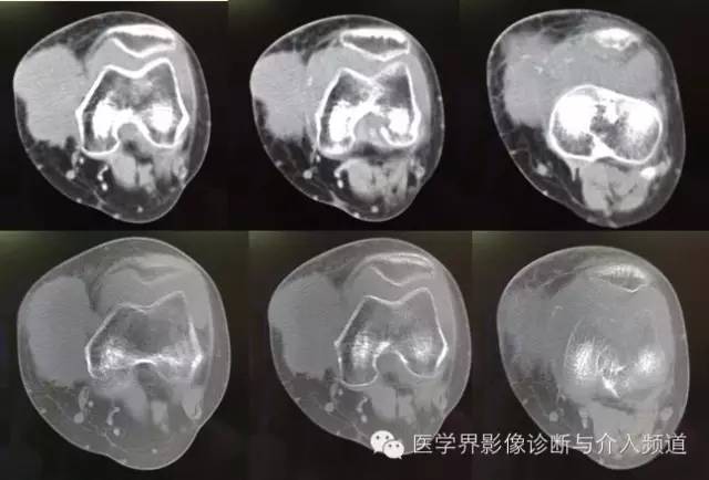 【病例】滑膜肉瘤2例CT及MR影像表现与鉴别 【病例】滑膜肉瘤2例CT及MR影像表现与鉴别