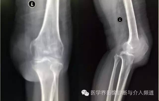 【病例】滑膜肉瘤2例CT及MR影像表现与鉴别 【病例】滑膜肉瘤2例CT及MR影像表现与鉴别