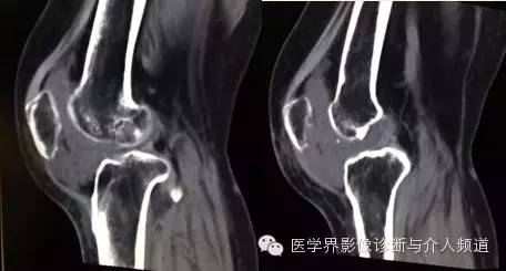 【病例】滑膜肉瘤2例CT及MR影像表现与鉴别 【病例】滑膜肉瘤2例CT及MR影像表现与鉴别