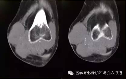 【病例】滑膜肉瘤2例CT及MR影像表现与鉴别 【病例】滑膜肉瘤2例CT及MR影像表现与鉴别