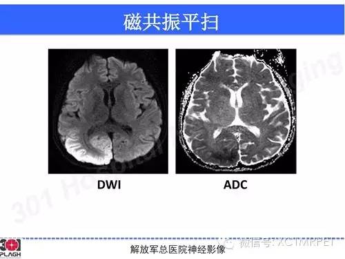 【病例】线粒体脑肌病1例MR影像诊断与思路分析
