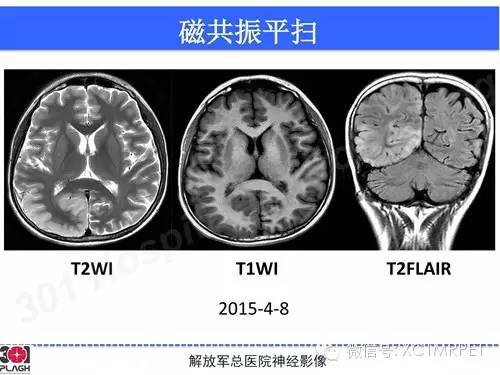 【病例】线粒体脑肌病1例MR影像诊断与思路分析