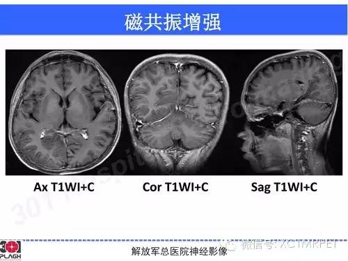 【病例】线粒体脑肌病1例MR影像诊断与思路分析