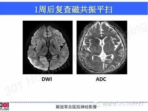 【病例】线粒体脑肌病1例MR影像诊断与思路分析