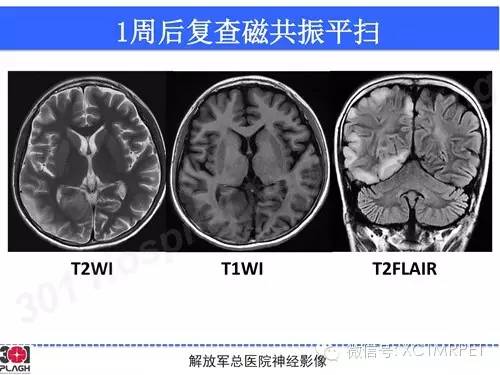 【病例】线粒体脑肌病1例MR影像诊断与思路分析