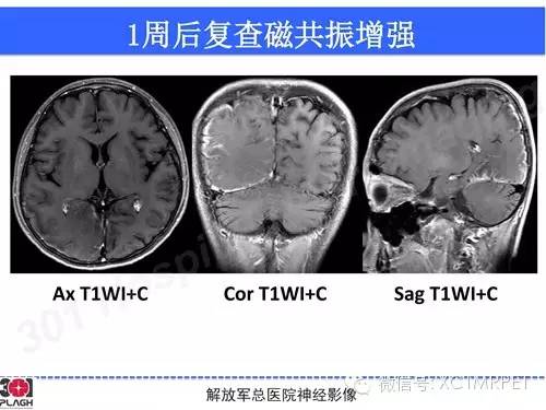 【病例】线粒体脑肌病1例MR影像诊断与思路分析