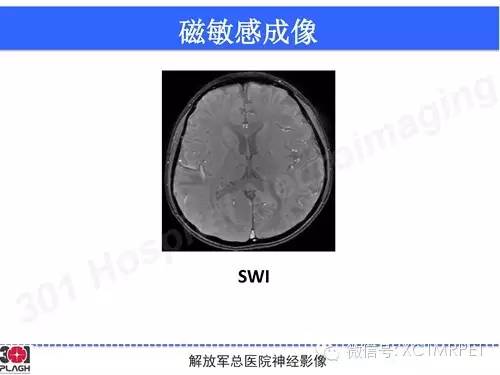 【病例】线粒体脑肌病1例MR影像诊断与思路分析