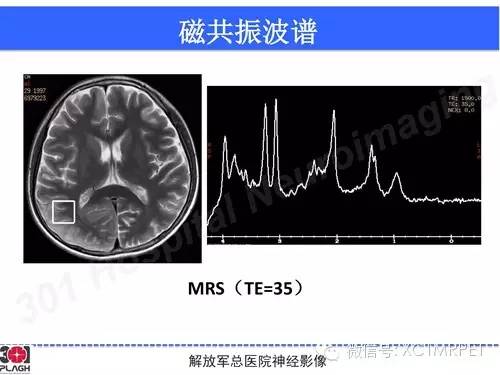 【病例】线粒体脑肌病1例MR影像诊断与思路分析