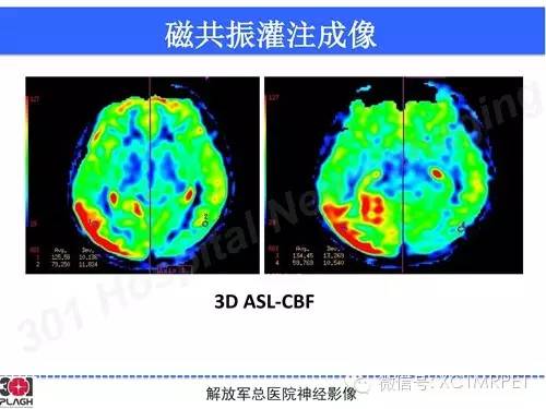 【病例】线粒体脑肌病1例MR影像诊断与思路分析