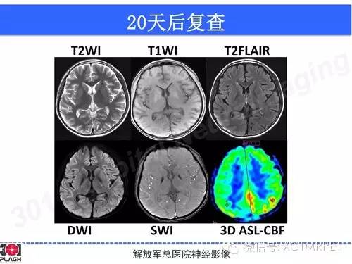 【病例】线粒体脑肌病1例MR影像诊断与思路分析