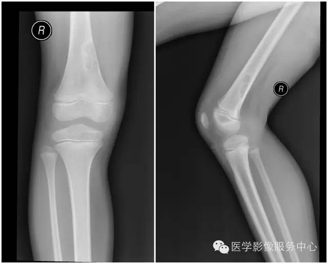 【病例】股骨良性纤维组织细胞瘤1例X线影像表现与鉴别