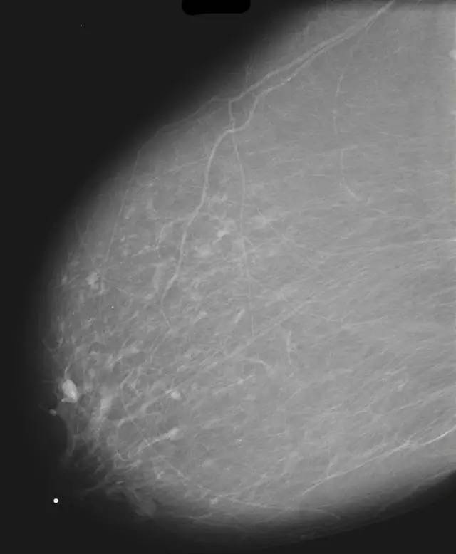 【病例】乳腺导管扩张症1例X线影像表现