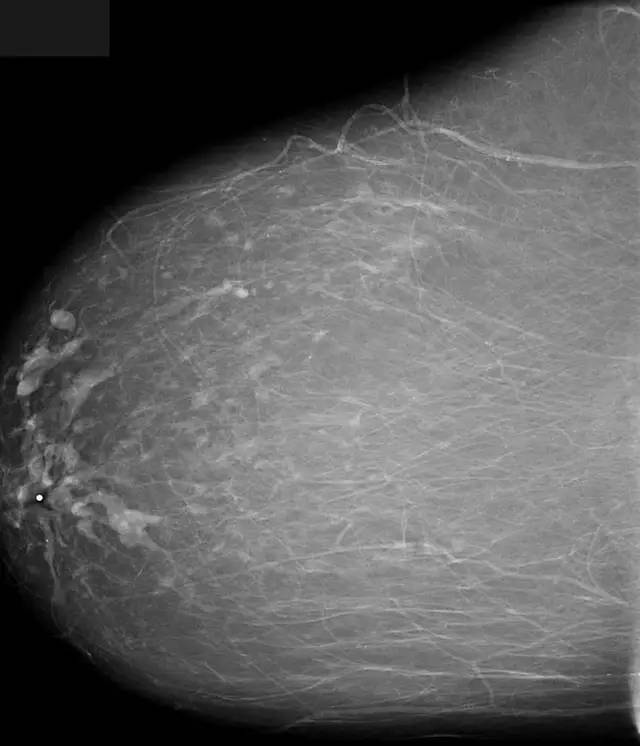【病例】乳腺导管扩张症1例X线影像表现 【病例】乳腺导管扩张症1例X线影像表现