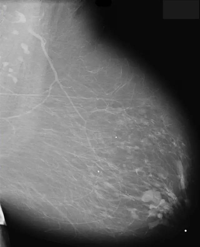 【病例】乳腺导管扩张症1例X线影像表现 【病例】乳腺导管扩张症1例X线影像表现