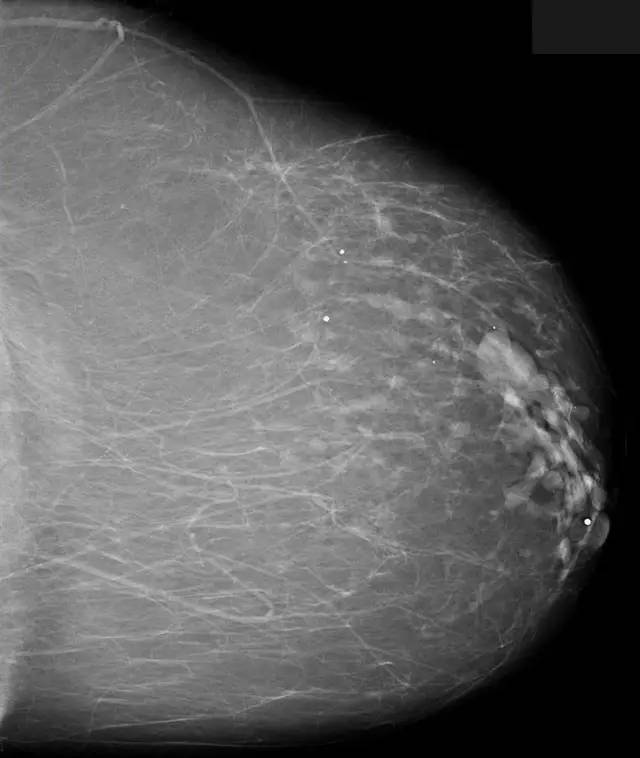 【病例】乳腺导管扩张症1例X线影像表现 【病例】乳腺导管扩张症1例X线影像表现