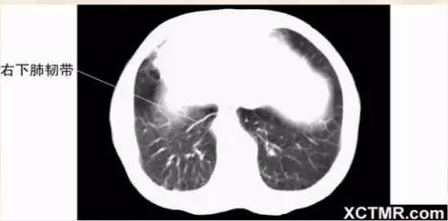 胸、腹、盆腔 CT解剖详解 胸、腹、盆腔 CT解剖详解