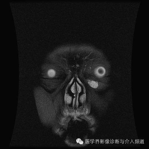 【病例】眼眶海绵状血管瘤1例MR影像表现