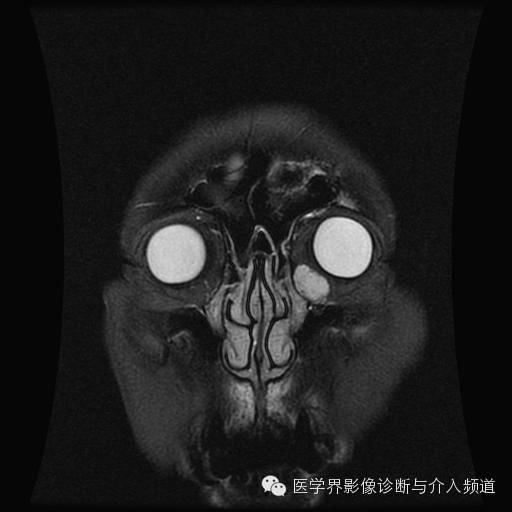 【病例】眼眶海绵状血管瘤1例MR影像表现 【病例】眼眶海绵状血管瘤1例MR影像表现