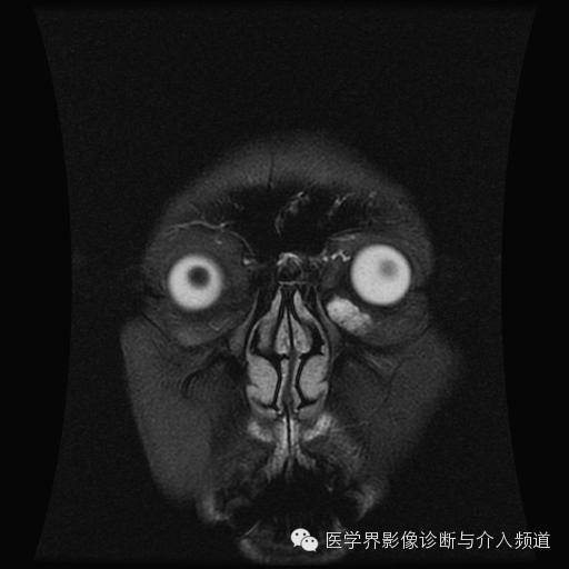 【病例】眼眶海绵状血管瘤1例MR影像表现 【病例】眼眶海绵状血管瘤1例MR影像表现