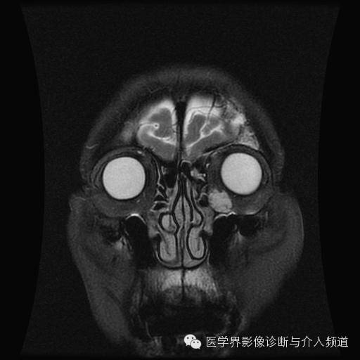 【病例】眼眶海绵状血管瘤1例MR影像表现 【病例】眼眶海绵状血管瘤1例MR影像表现