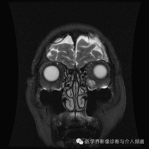 【病例】眼眶海绵状血管瘤1例MR影像表现 【病例】眼眶海绵状血管瘤1例MR影像表现