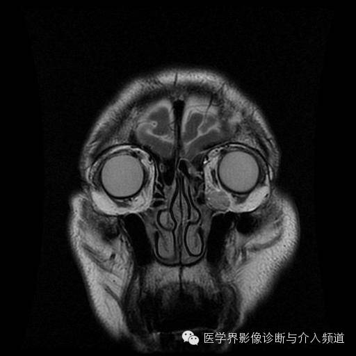 【病例】眼眶海绵状血管瘤1例MR影像表现 【病例】眼眶海绵状血管瘤1例MR影像表现