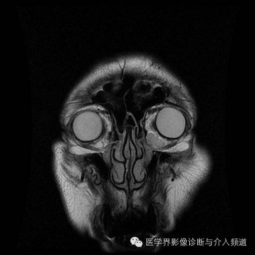 【病例】眼眶海绵状血管瘤1例MR影像表现 【病例】眼眶海绵状血管瘤1例MR影像表现