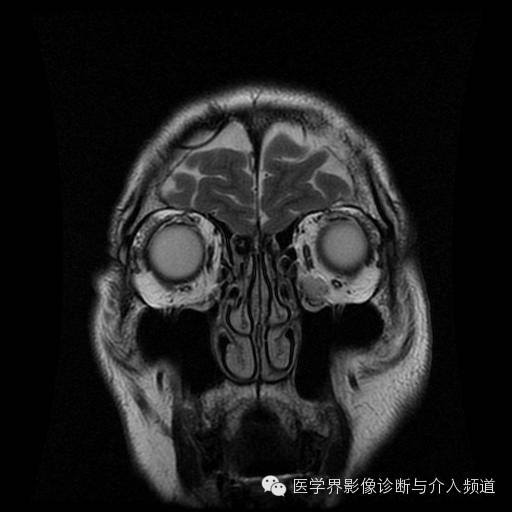【病例】眼眶海绵状血管瘤1例MR影像表现 【病例】眼眶海绵状血管瘤1例MR影像表现