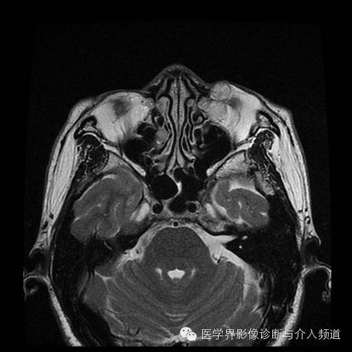 【病例】眼眶海绵状血管瘤1例MR影像表现 【病例】眼眶海绵状血管瘤1例MR影像表现