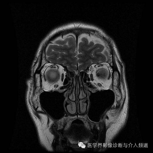 【病例】眼眶海绵状血管瘤1例MR影像表现 【病例】眼眶海绵状血管瘤1例MR影像表现