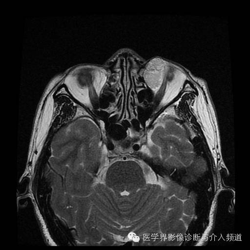 【病例】眼眶海绵状血管瘤1例MR影像表现 【病例】眼眶海绵状血管瘤1例MR影像表现