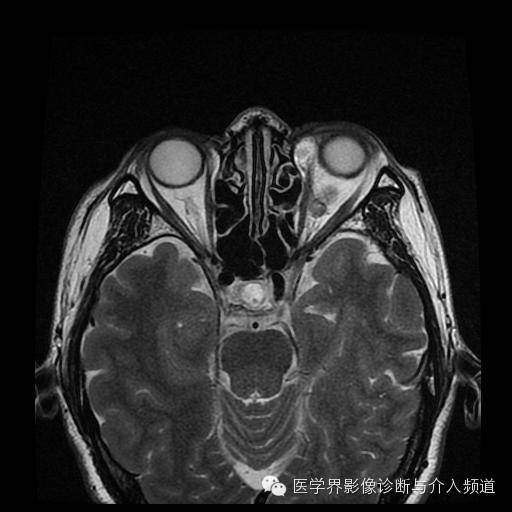 【病例】眼眶海绵状血管瘤1例MR影像表现 【病例】眼眶海绵状血管瘤1例MR影像表现