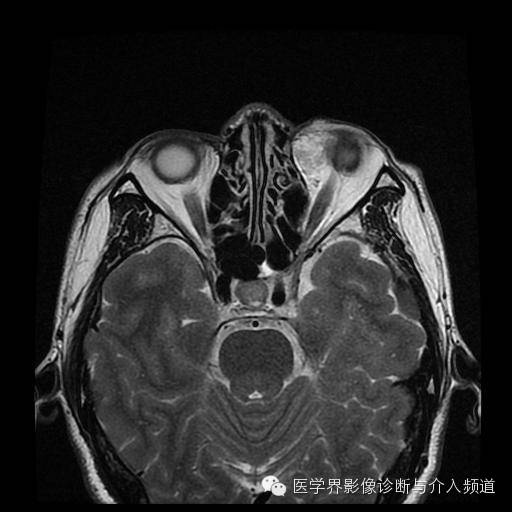 【病例】眼眶海绵状血管瘤1例MR影像表现 【病例】眼眶海绵状血管瘤1例MR影像表现