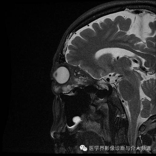 【病例】眼眶海绵状血管瘤1例MR影像表现 【病例】眼眶海绵状血管瘤1例MR影像表现