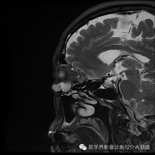 【病例】眼眶海绵状血管瘤1例MR影像表现 【病例】眼眶海绵状血管瘤1例MR影像表现
