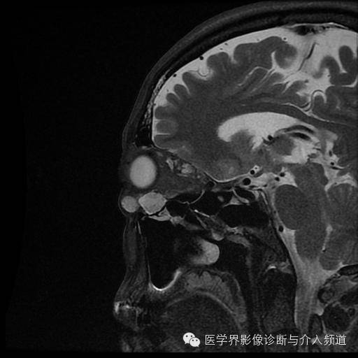 【病例】眼眶海绵状血管瘤1例MR影像表现 【病例】眼眶海绵状血管瘤1例MR影像表现