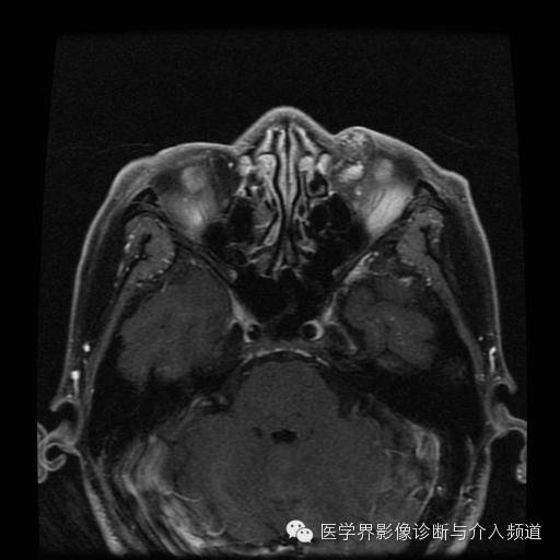 【病例】眼眶海绵状血管瘤1例MR影像表现 【病例】眼眶海绵状血管瘤1例MR影像表现
