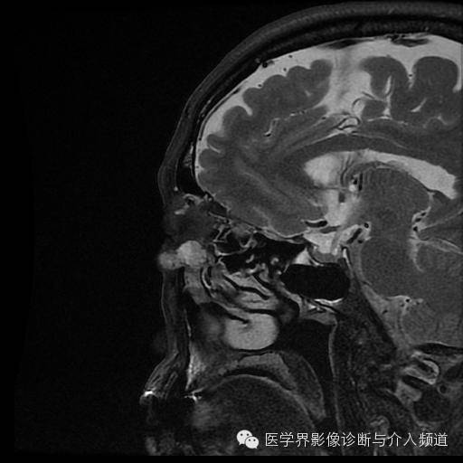 【病例】眼眶海绵状血管瘤1例MR影像表现 【病例】眼眶海绵状血管瘤1例MR影像表现
