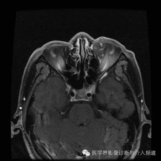 【病例】眼眶海绵状血管瘤1例MR影像表现 【病例】眼眶海绵状血管瘤1例MR影像表现