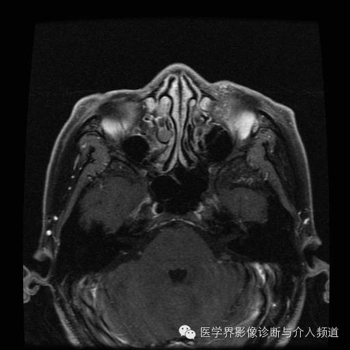 【病例】眼眶海绵状血管瘤1例MR影像表现 【病例】眼眶海绵状血管瘤1例MR影像表现