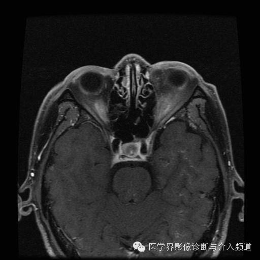 【病例】眼眶海绵状血管瘤1例MR影像表现 【病例】眼眶海绵状血管瘤1例MR影像表现