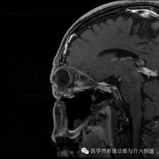 【病例】眼眶海绵状血管瘤1例MR影像表现 【病例】眼眶海绵状血管瘤1例MR影像表现