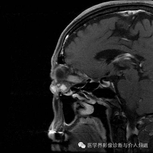 【病例】眼眶海绵状血管瘤1例MR影像表现 【病例】眼眶海绵状血管瘤1例MR影像表现