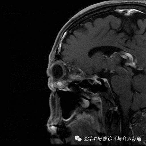【病例】眼眶海绵状血管瘤1例MR影像表现 【病例】眼眶海绵状血管瘤1例MR影像表现