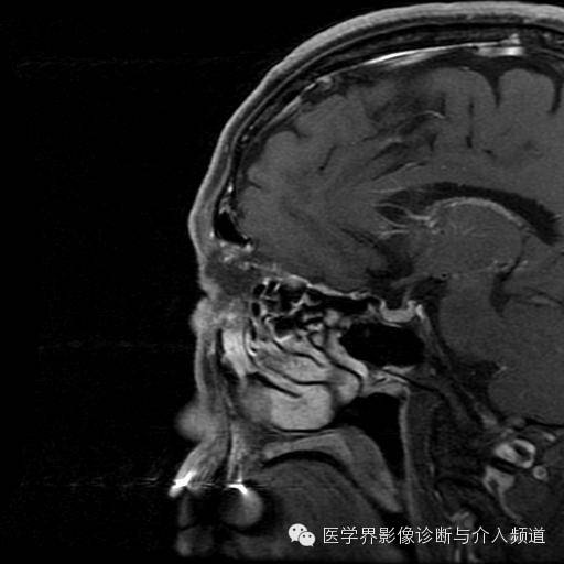 【病例】眼眶海绵状血管瘤1例MR影像表现 【病例】眼眶海绵状血管瘤1例MR影像表现